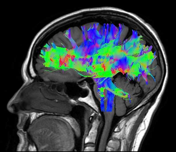 MR_GBL_1.5T_Voyager_Clinical_Brain-DTI-FiberTrak_0309