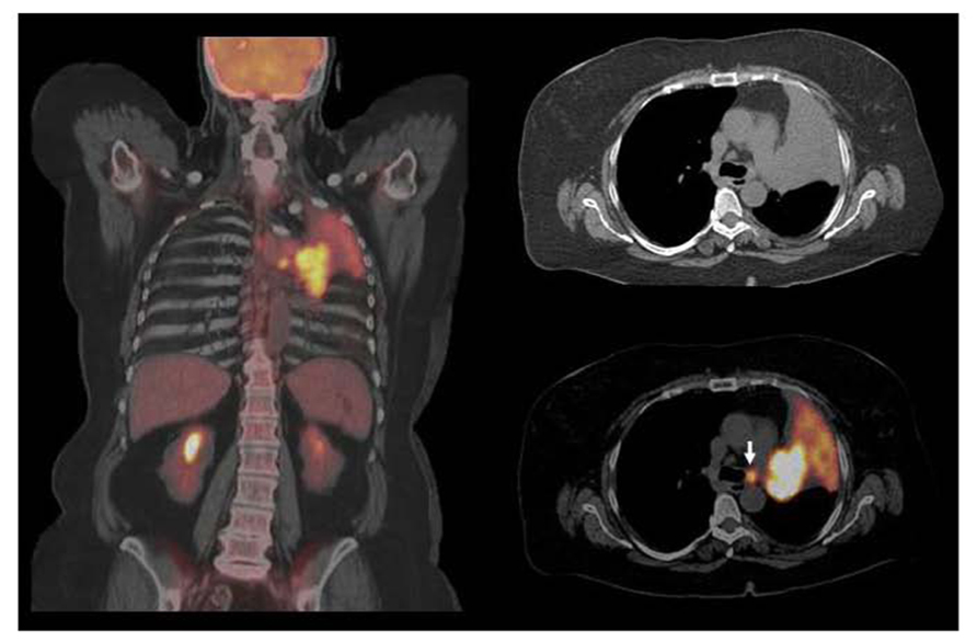 Current concepts in F18 FDG PET/CT-based radiation therapy plann